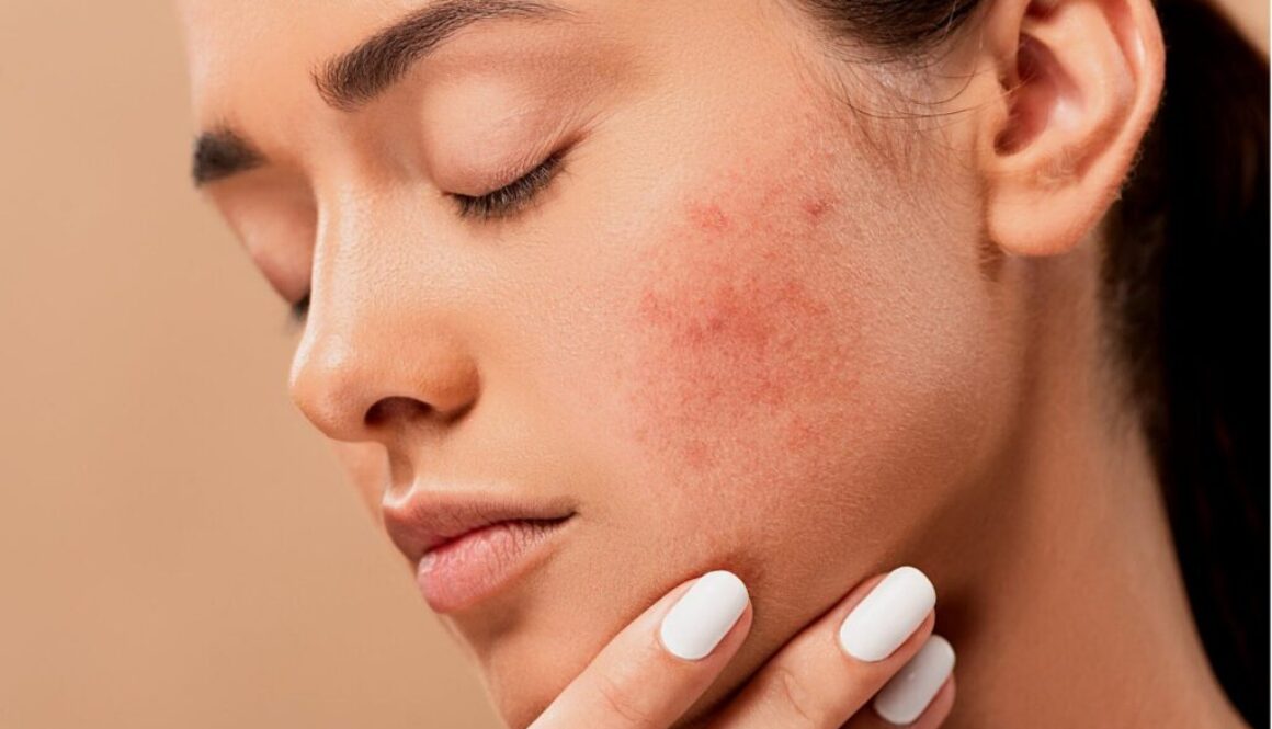 How to treat acne caused by dandruff