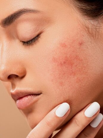 How to treat acne caused by dandruff