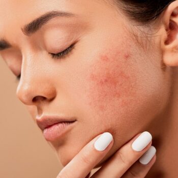 How to treat acne caused by dandruff