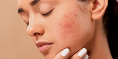 How to treat acne caused by dandruff