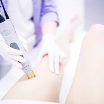 guide to laser hair removal